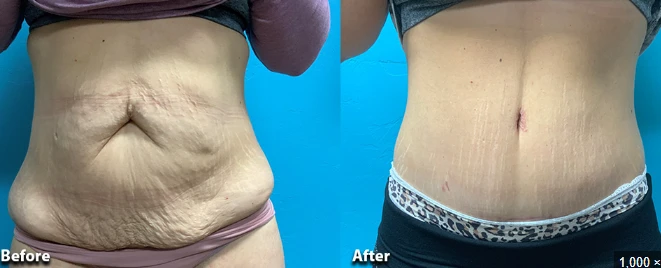 Tummy Tuck Scars and Self-Confidence: What to Expect Emotionally
