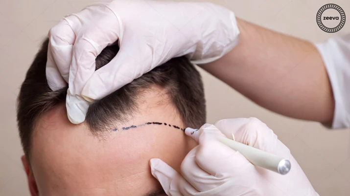 Discover the Modern Solutions for Hair Transplant in Ahmedabad India