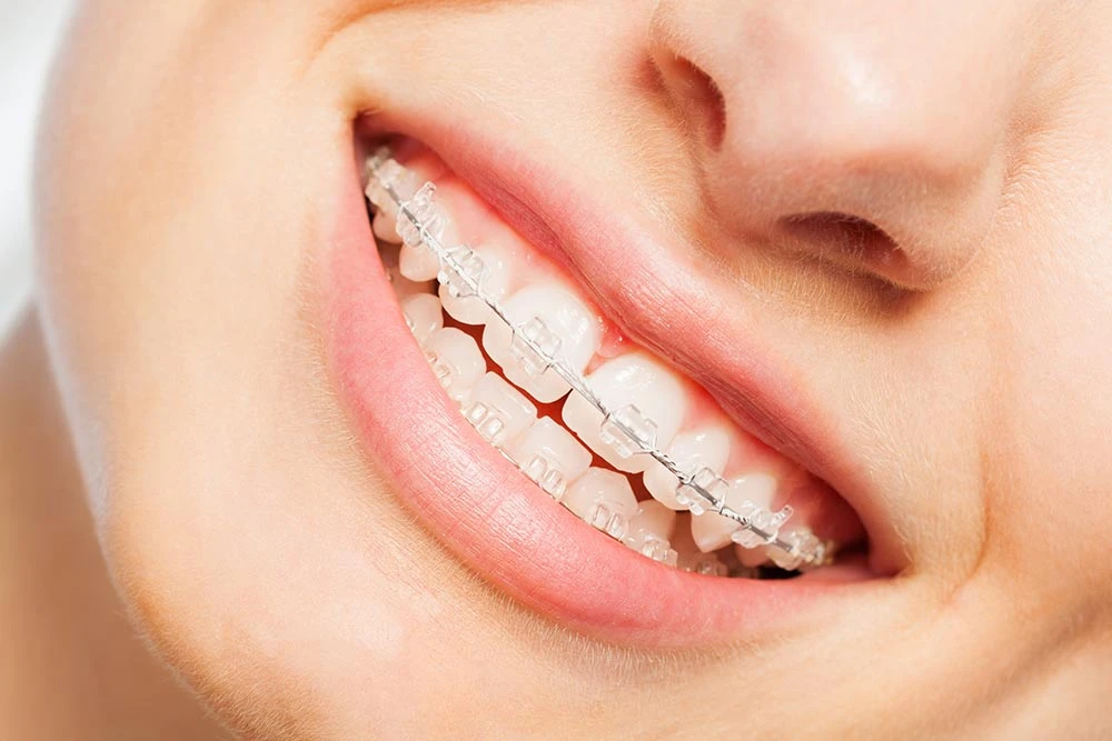 Why Choose Braces Orthodontics for a Better Smile?