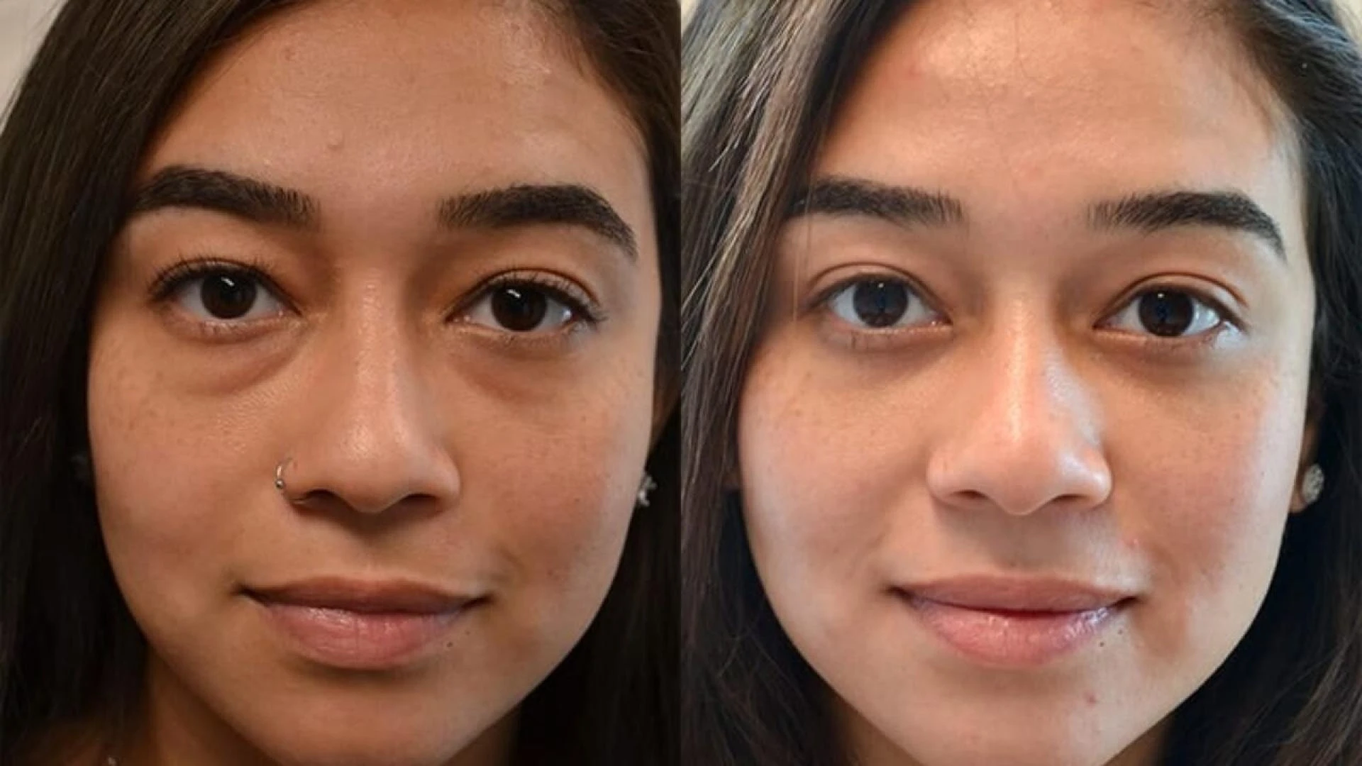 The Complete Guide to Lower Blepharoplasty Cape Town: What to Expect & Why It Works