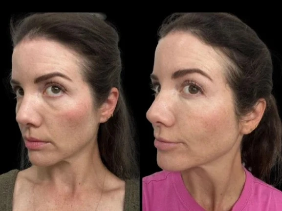Natural-Looking Results for Dark Circles Treatment with the Best Plastic Surgeon in Dubai