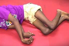 Speech and Language Therapy for Spastic Quadriplegic Cerebral Palsy