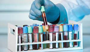 How should patients prepare for an iron binding capacity test?