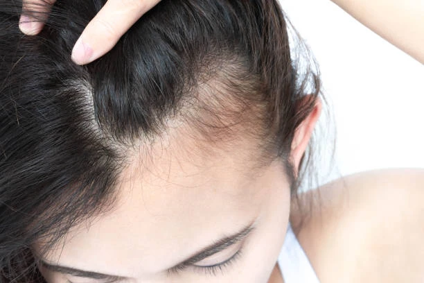 5 Myths About Female Hair Transplants That Are Totally Outdated