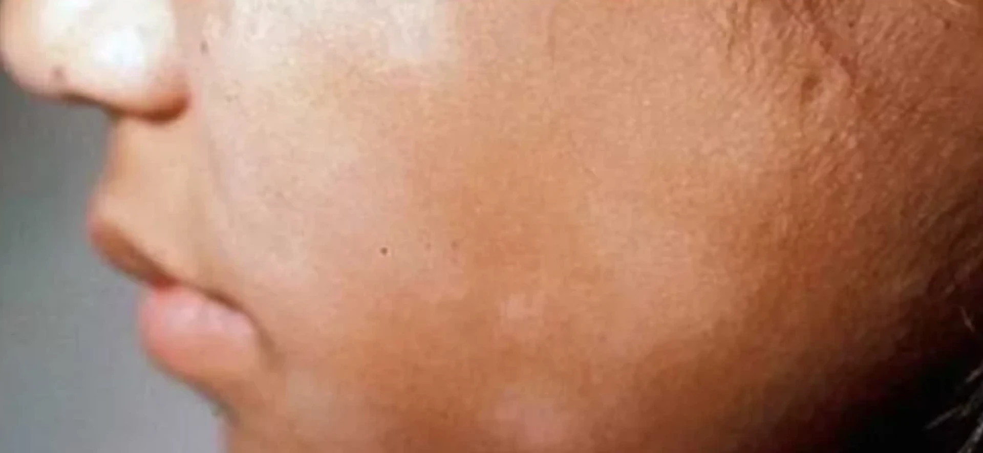 Sehua Kee Dava Ghareloo | Vitiligo Treatment in India