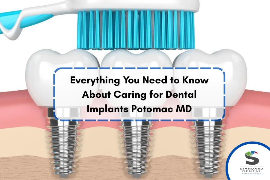 Everything You Need to Know About Caring for Dental Implants Potomac MD