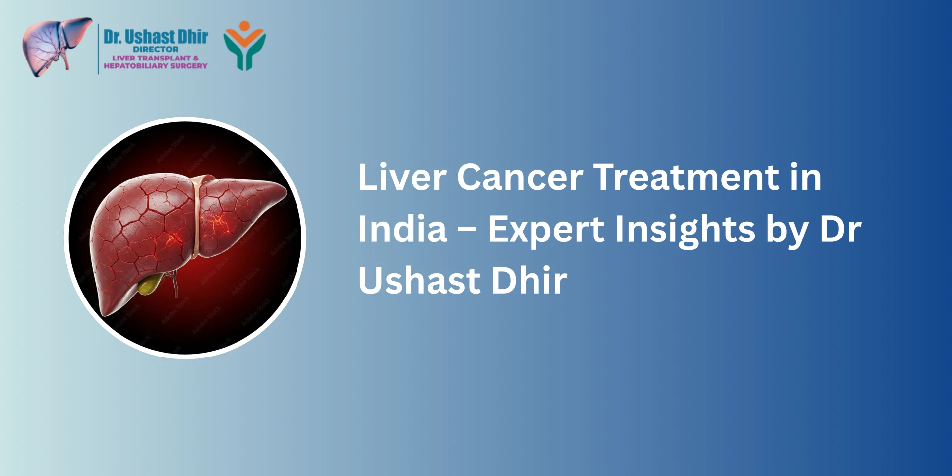 Liver Cancer Treatment in India — Expert Insights by Dr Ushast Dhir