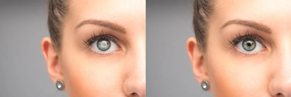 7 Tips for Preventing Cataracts