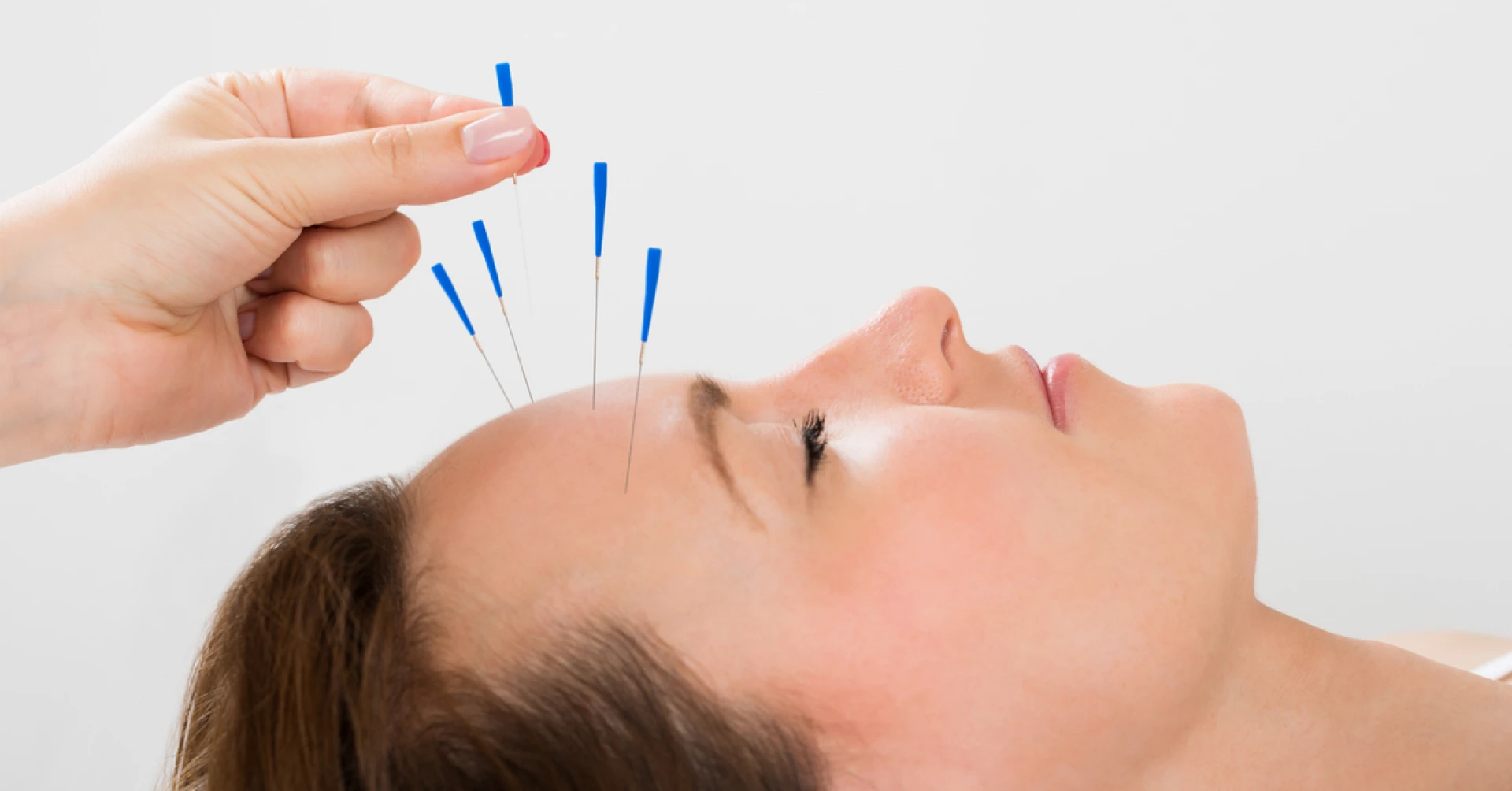 Why More People Are Choosing Headaches Acupuncture Middle Tennessee for Migraine Relief