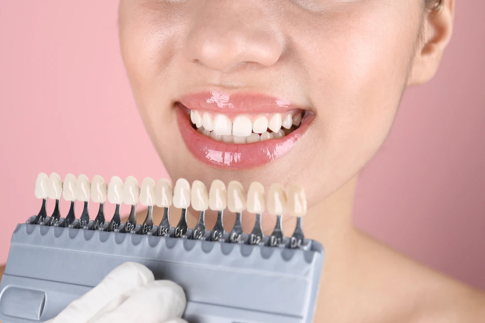 Essential Care Tips for Maintaining Veneers in Miami FL