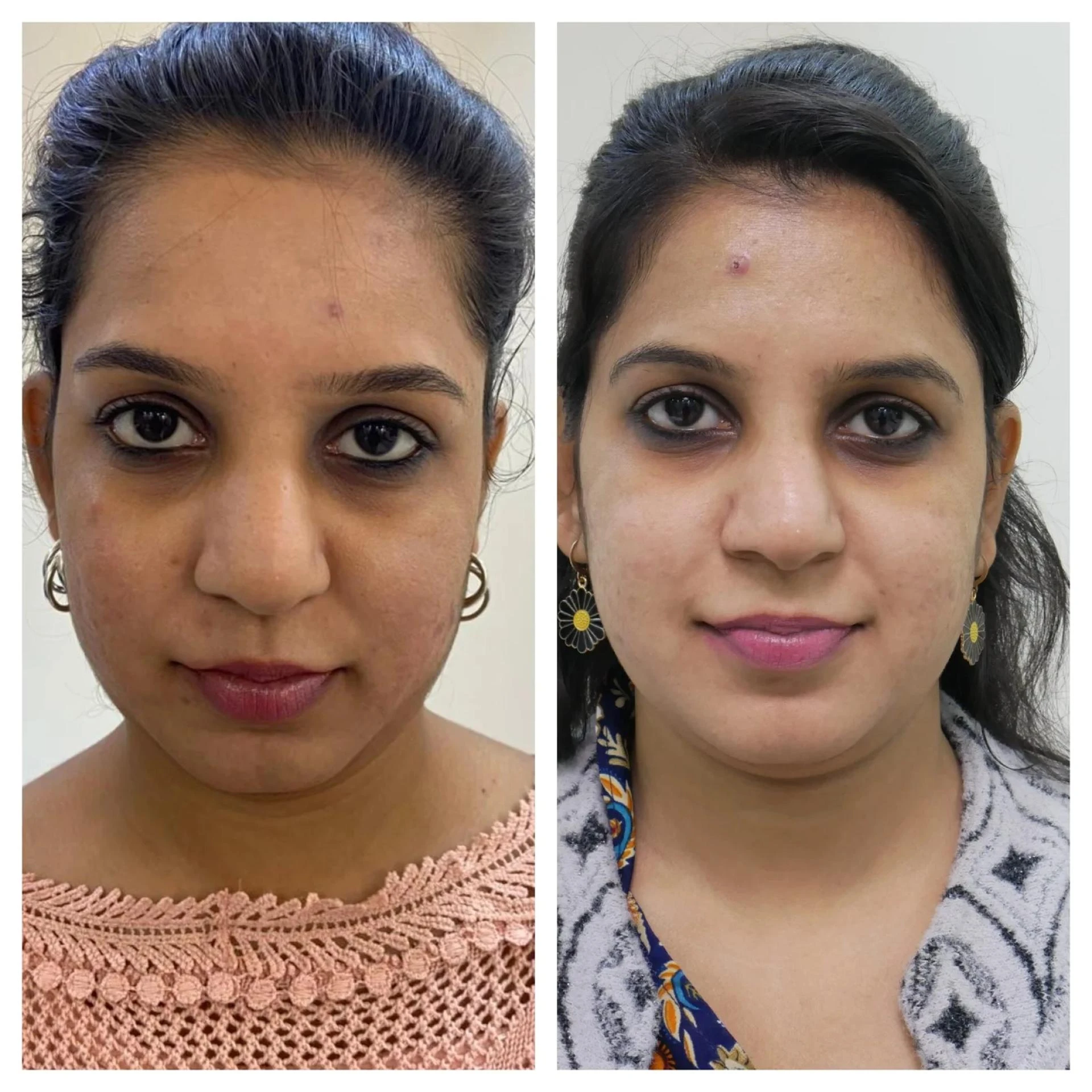 Benefits of Glutathione Skin Whitening Treatment at Leading Skin Care Clinics in Bhopal, Madhya Pradesh