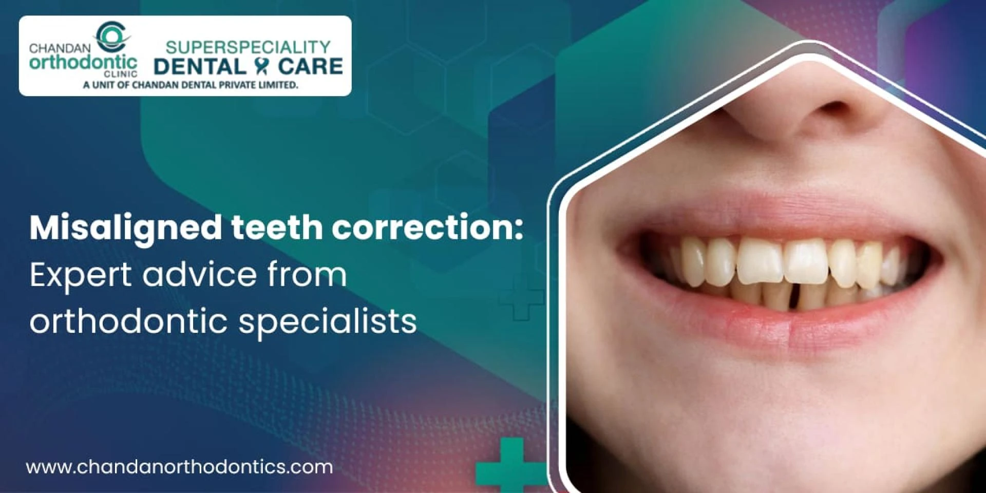 Misaligned teeth correction - Expert advice from orthodontic specialists