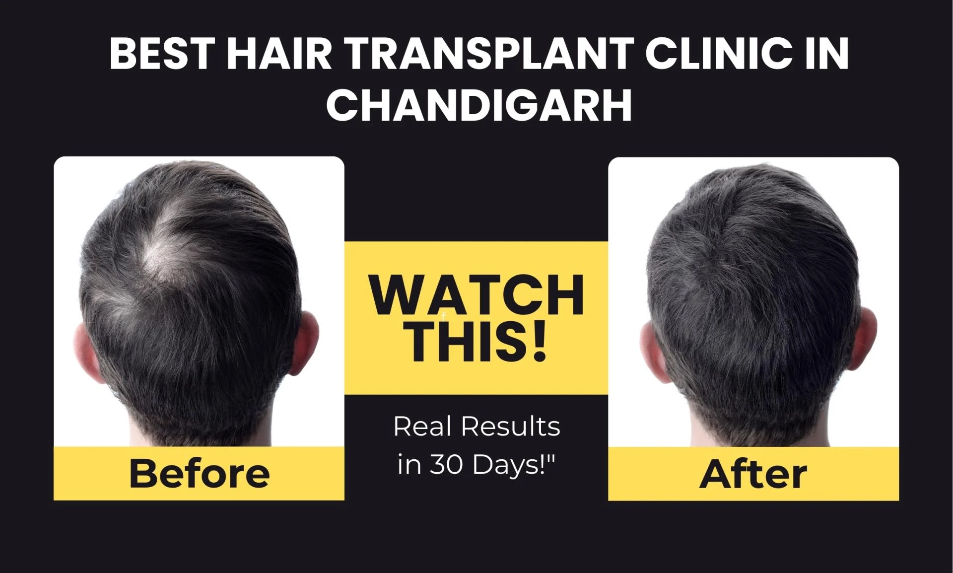 Finding the Best Hair Transplant Clinic in Chandigarh Made Easy