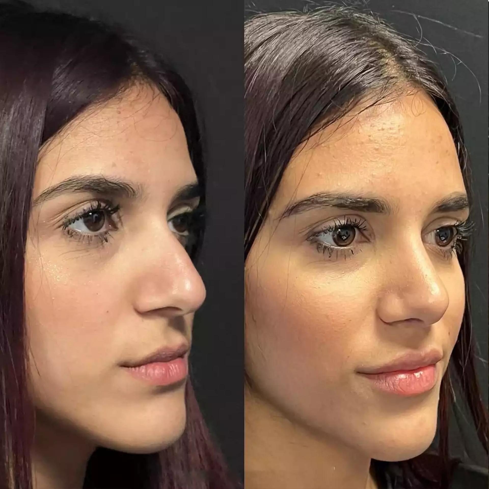 How Do the Best Doctors in Dubai Approach Rhinoplasty Consultation?