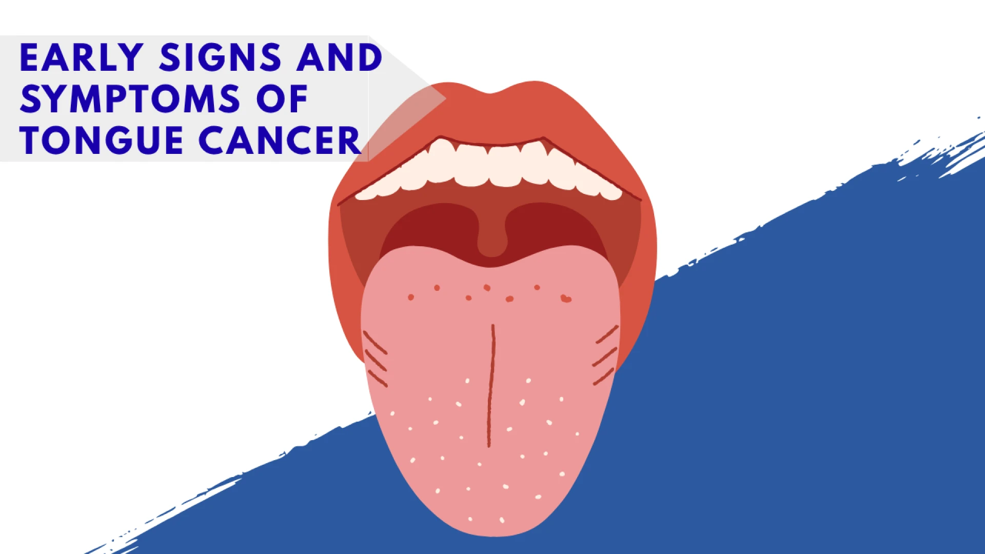 Early Signs and Symptoms of Tongue Cancer