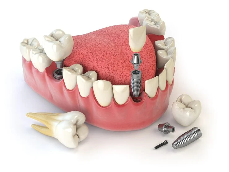 Dental Implants in Chennai: Where to Go?