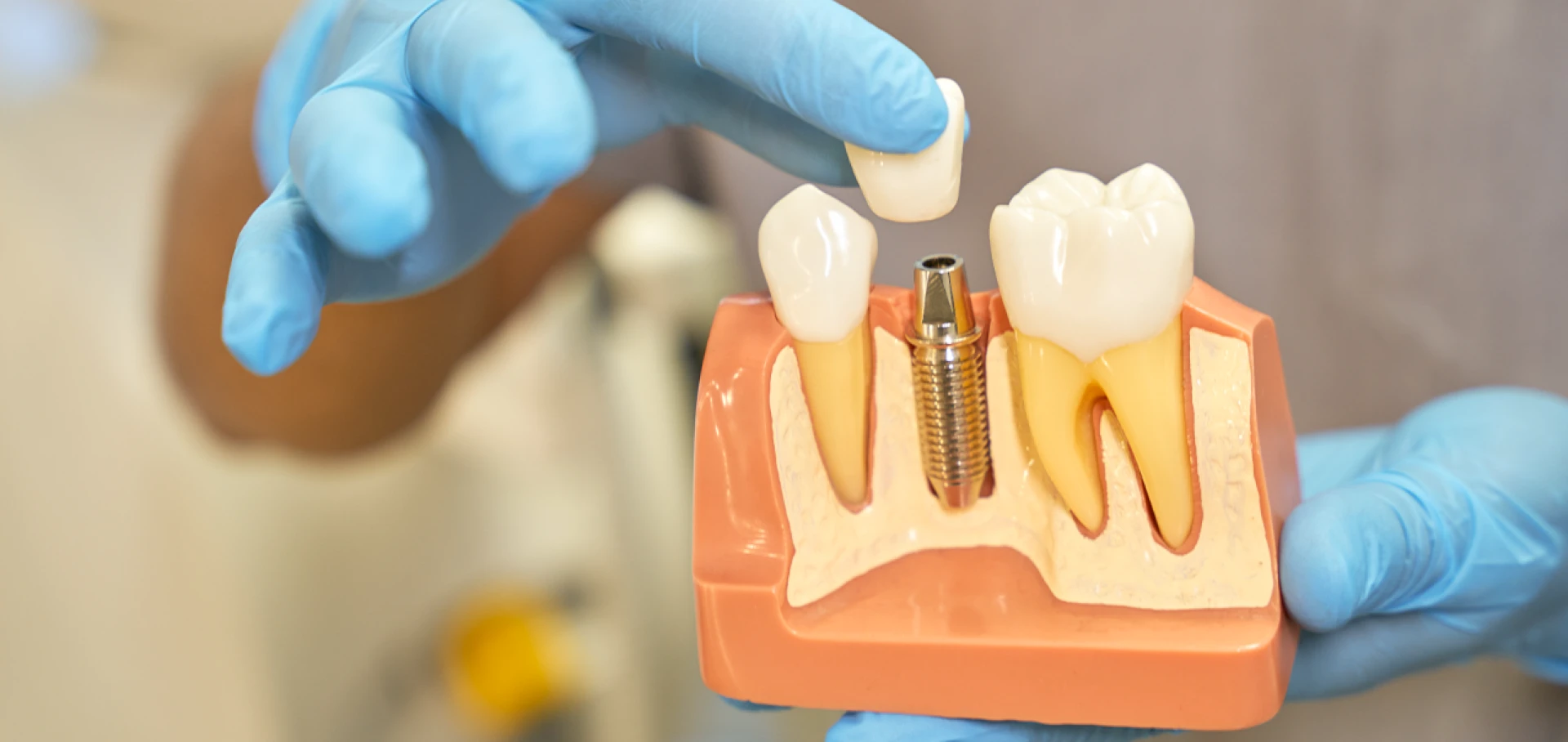 Types of Dental Implants: Choosing the Right Option for You in India