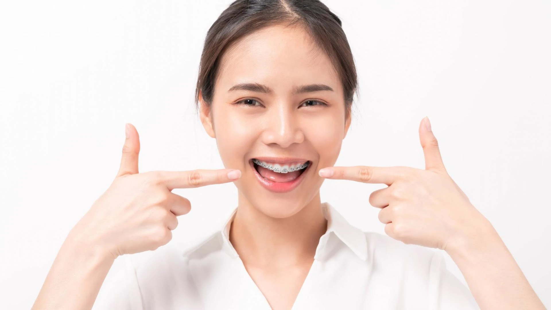 Helping Your Teen Smile With Confidence: The Best Braces Options in Long Beach, CA