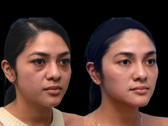 How the Best plastic surgeons in Dubai treat dark circles for long-lasting results