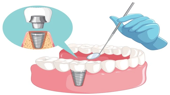 Dental Implants in South East London: A Modern Solution for Lasting Smiles