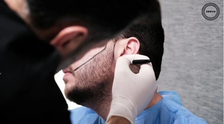 Best Beard Hair Transplant Techniques for Natural Looking Results
