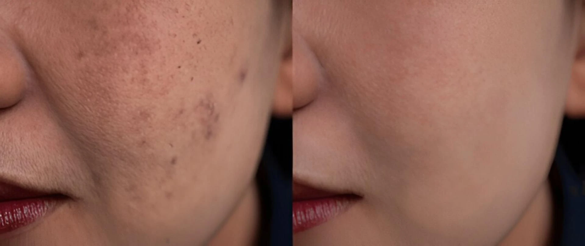 Understanding Melasma: Top Symptoms and Major Causes