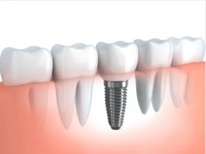 Bone Loss and Missing Teeth: How Fixed Implants Help Fix the Problem  