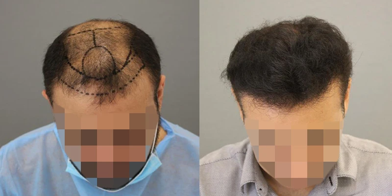 Hair Transplant in Abu Dhabi: Expert Tips for Faster Recovery
