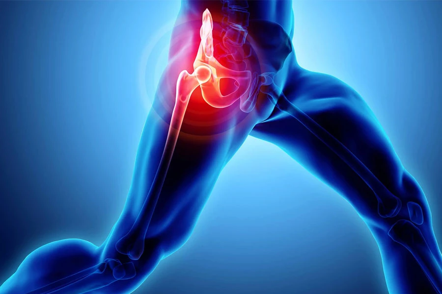 A Holistic Approach to Healing: Avascular Necrosis Treatment in Noida