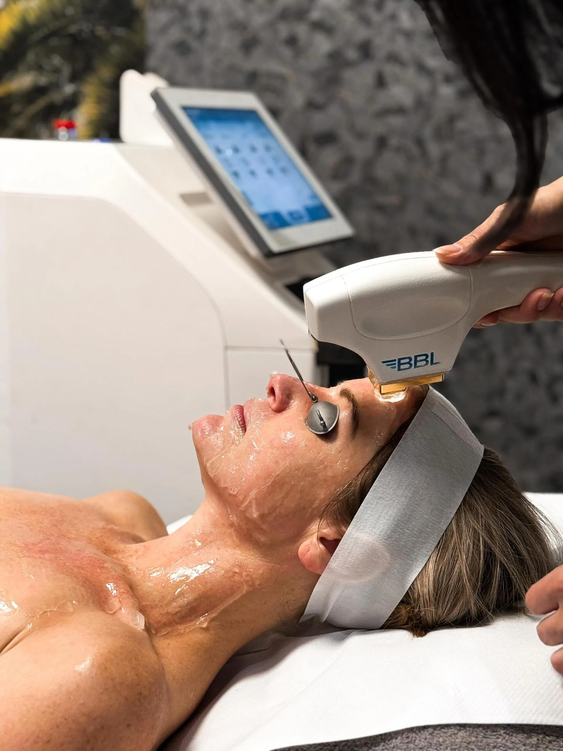 Ablative Laser Resurfacing & Laser Resurfacing: Your Guide to Smoother, Rejuvenated Skin