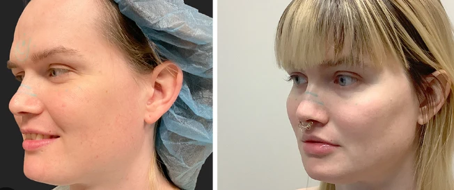 Preparing for Facial Feminization Surgery
