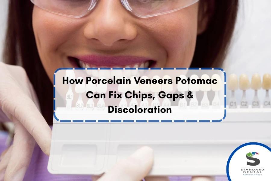 How Porcelain Veneers Potomac Can Fix Chips, Gaps & Discoloration