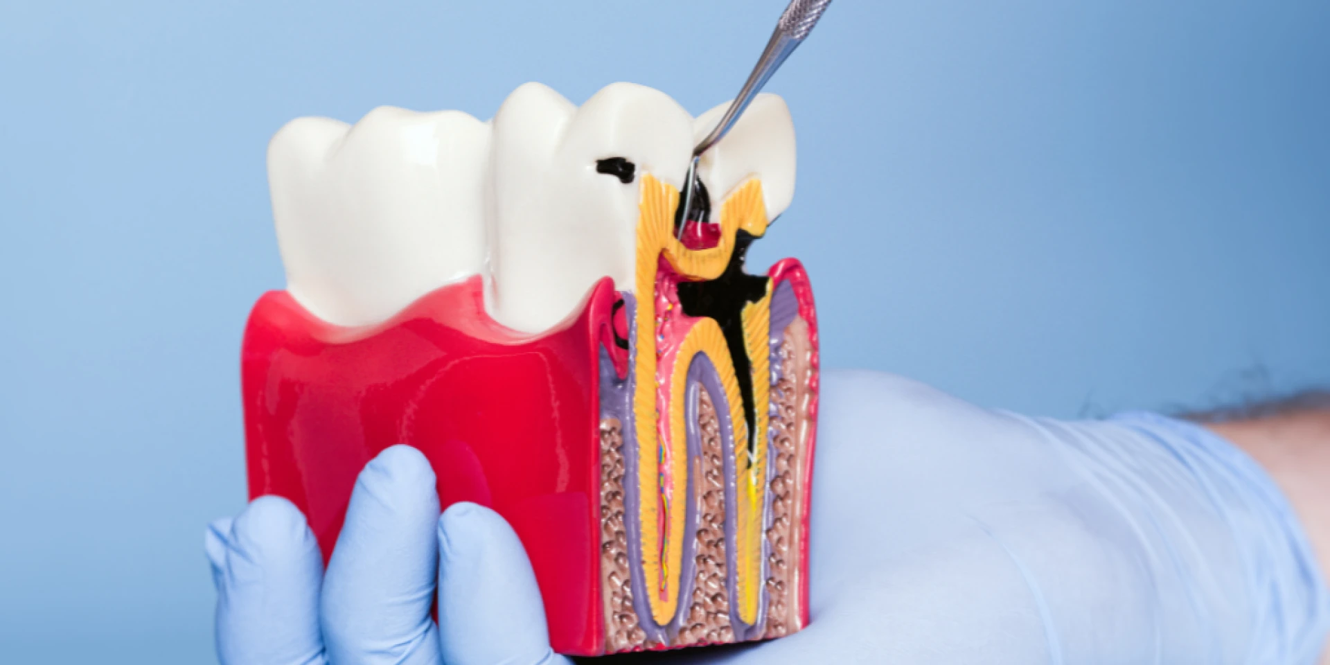 Why Root Canal Treatment Matters for Children in Brampton: A Parent’s Guide