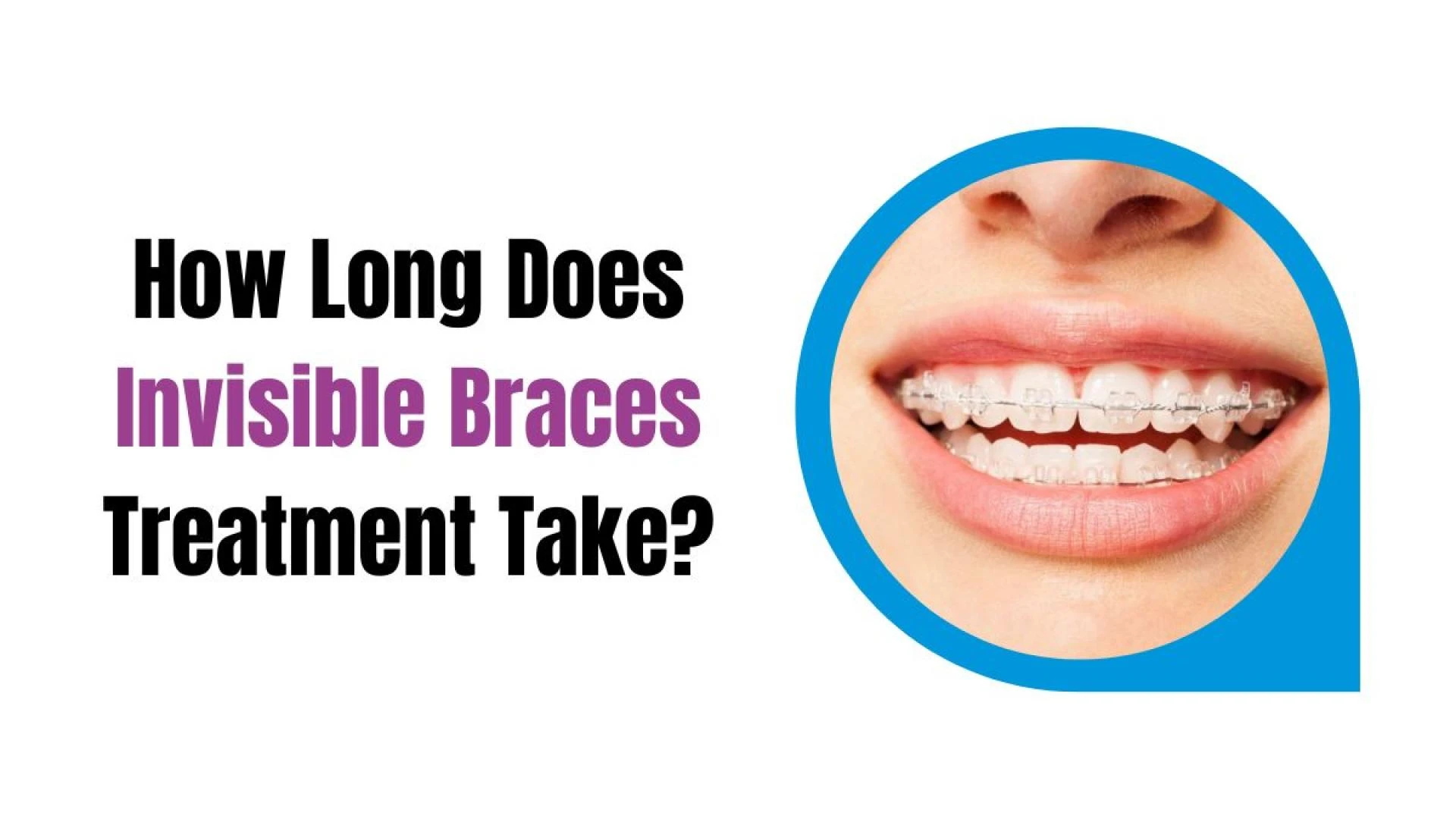 How Long Does Invisible Braces Treatment Take?