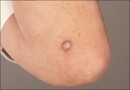 Ayurvedic aspect of Keratoacanthoma