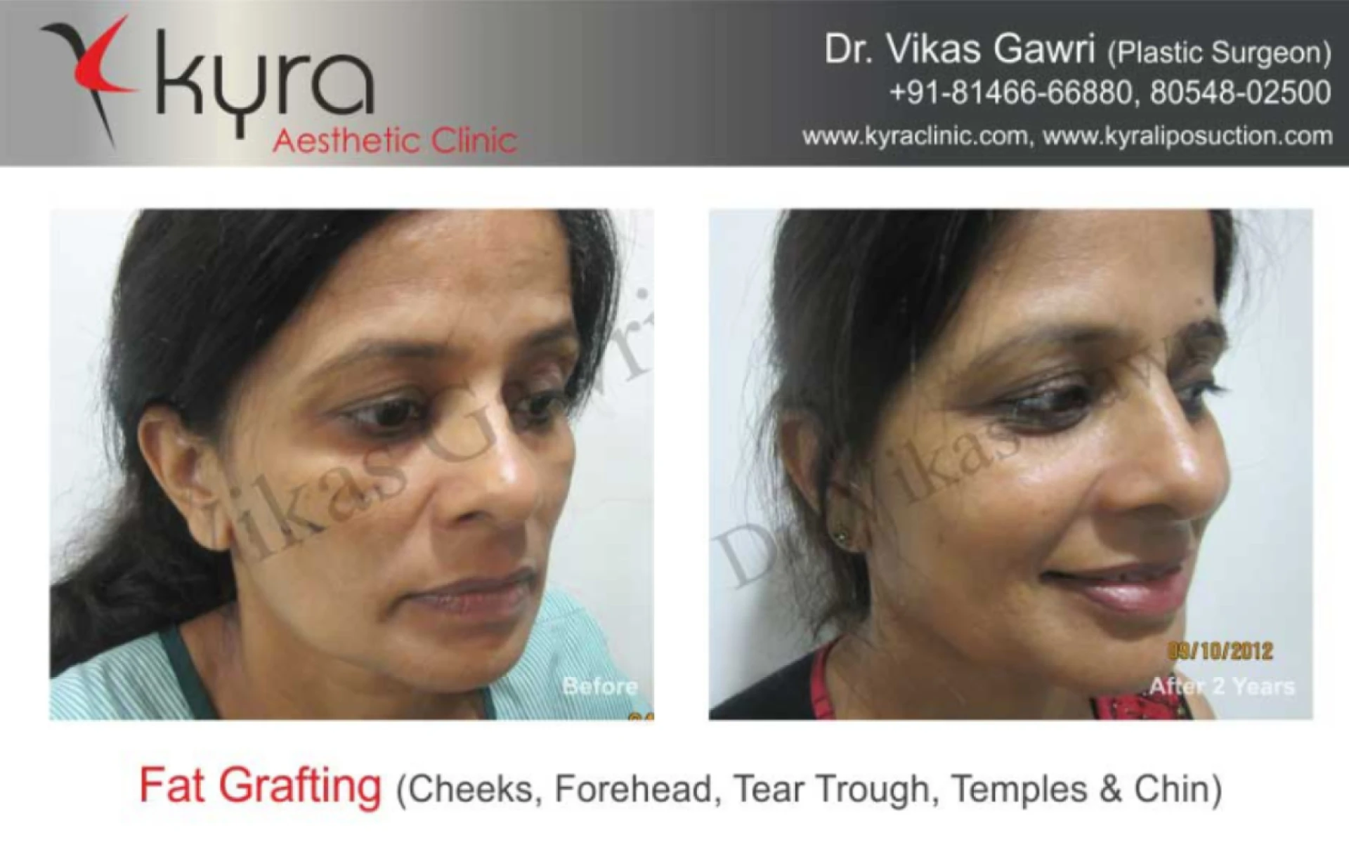 Best Surgeon for Fat Transfer to Face in Ludhiana