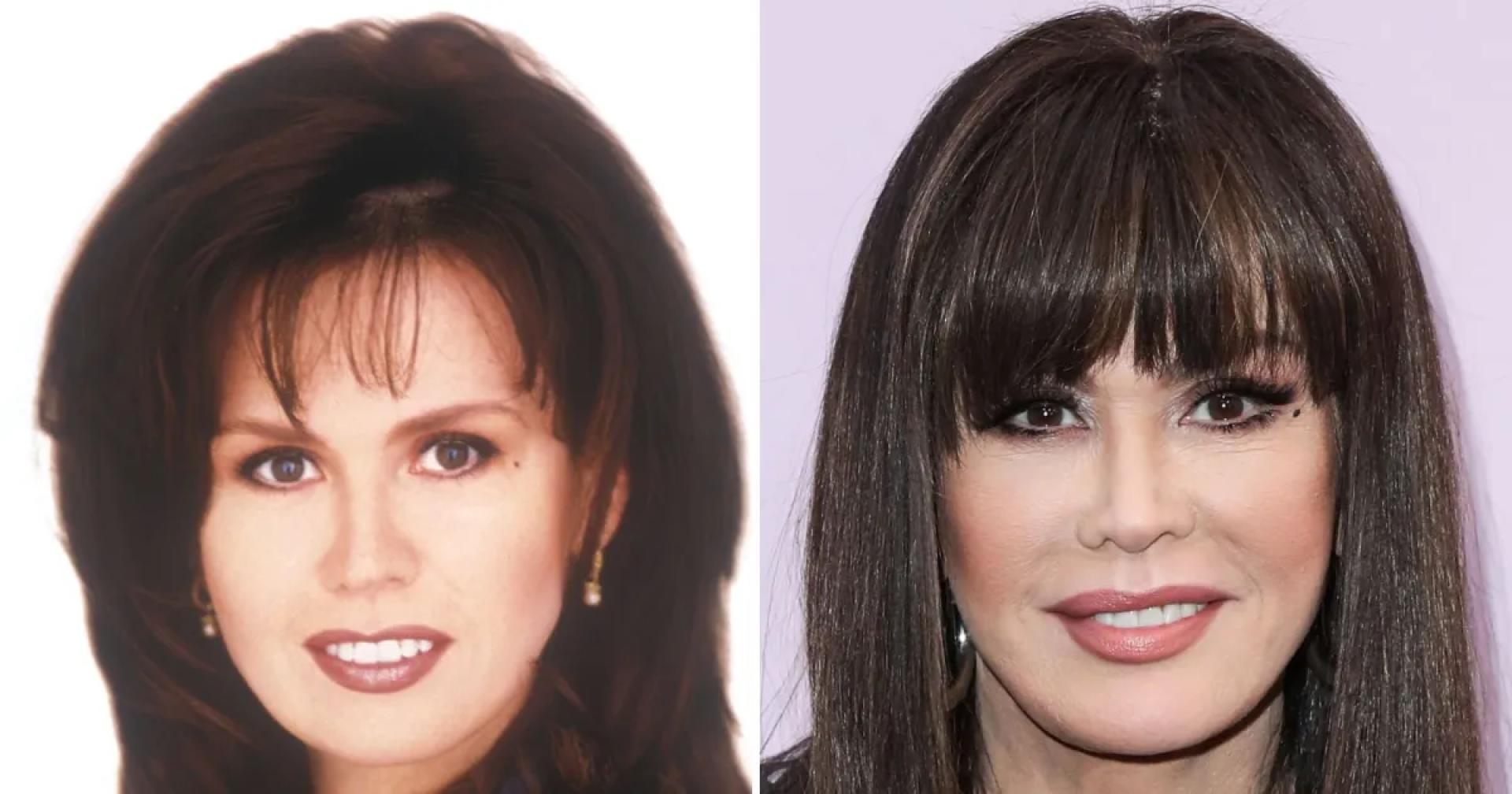 Marie Osmond Plastic Surgery: Truth, Rumors, and Transformation