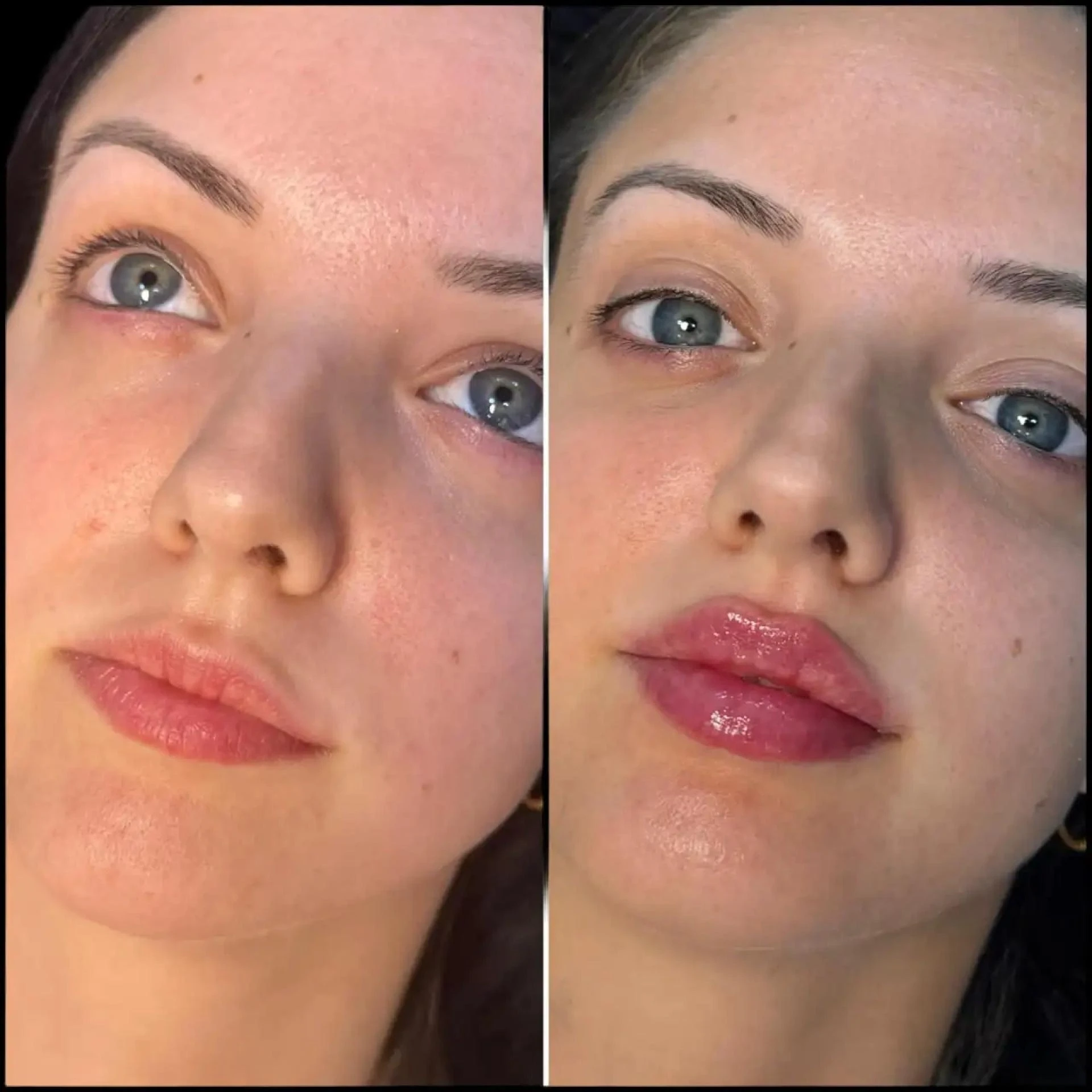 Top Best Aesthetic Clinics in Dubai for Fillers High-Quality Care