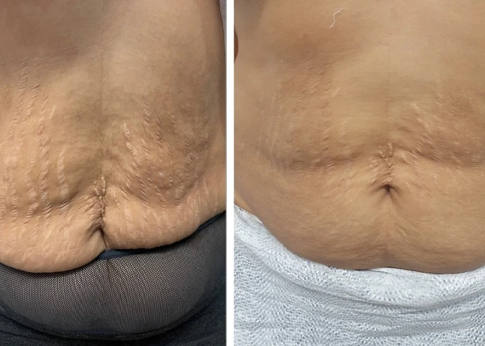 Stretch Mark Removal Treatment – Safe, Effective & Dermatologist-Approved