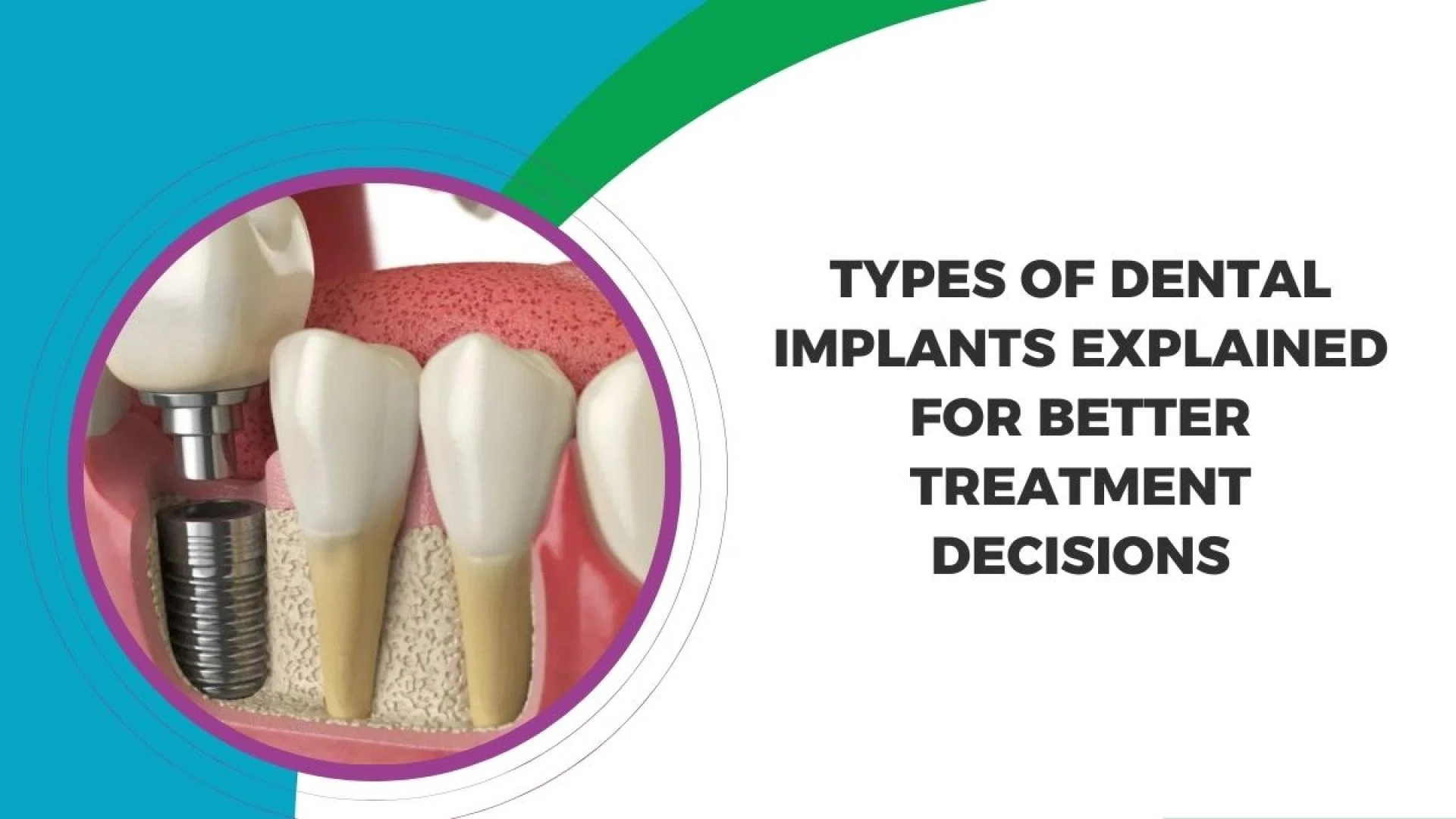 Types of Dental Implants: Understanding Options for Different Dental Needs