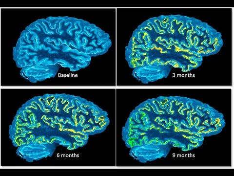 Why Targeting Neuroinflammation Might Be the Next Big Shift in Alzheimer’s Therapy