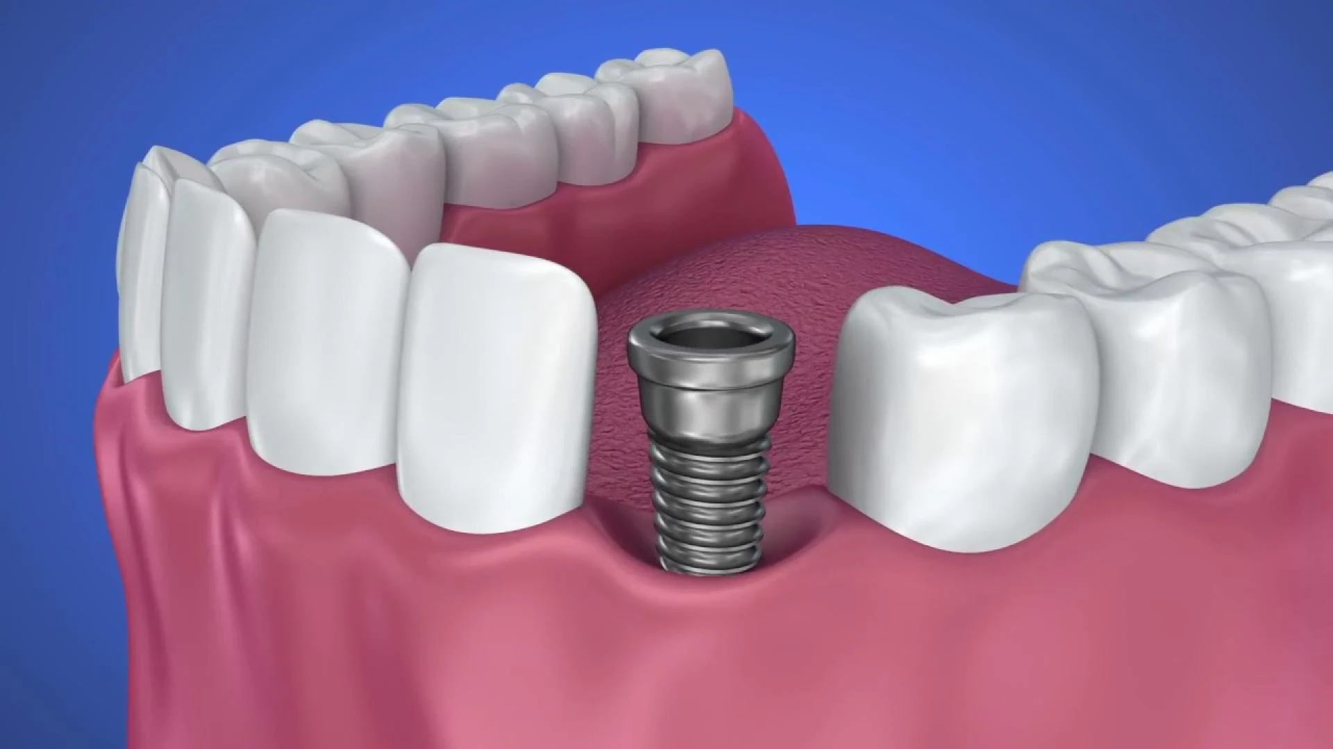 The Real Cost of Dental Implants in Dallas & What Affects It