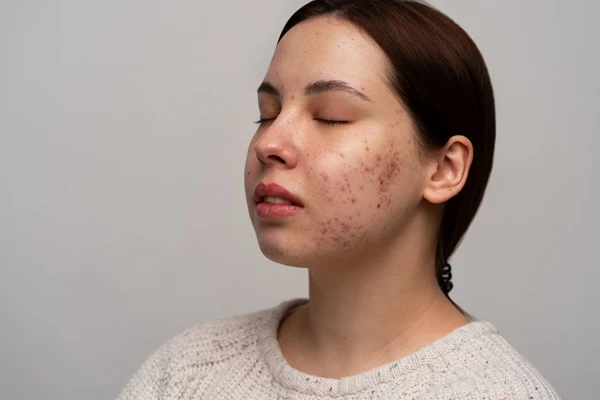 Acne Scar Removal for Face in Kolkata by Dr Oindrila Dutta