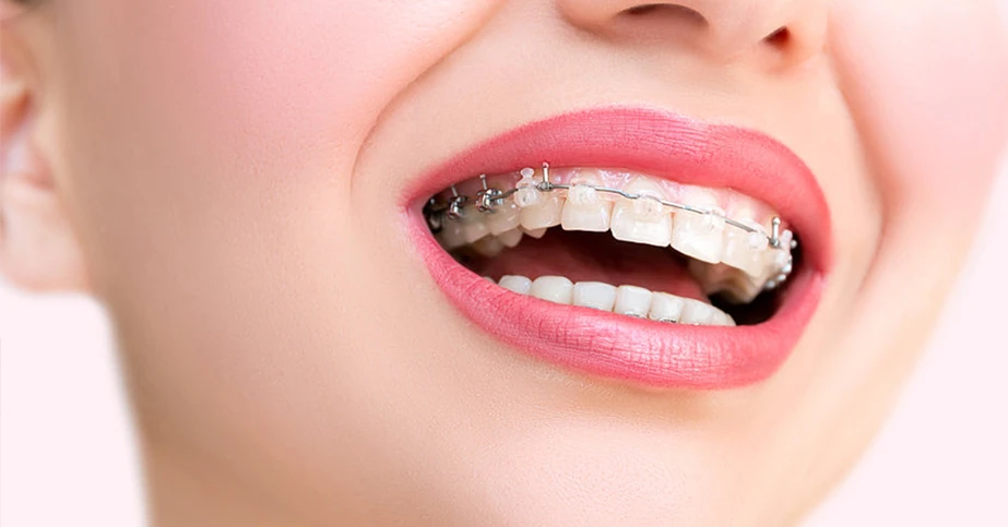 Braces For Teeth Alignment In Delhi: Treatment Options And Costs Explained!