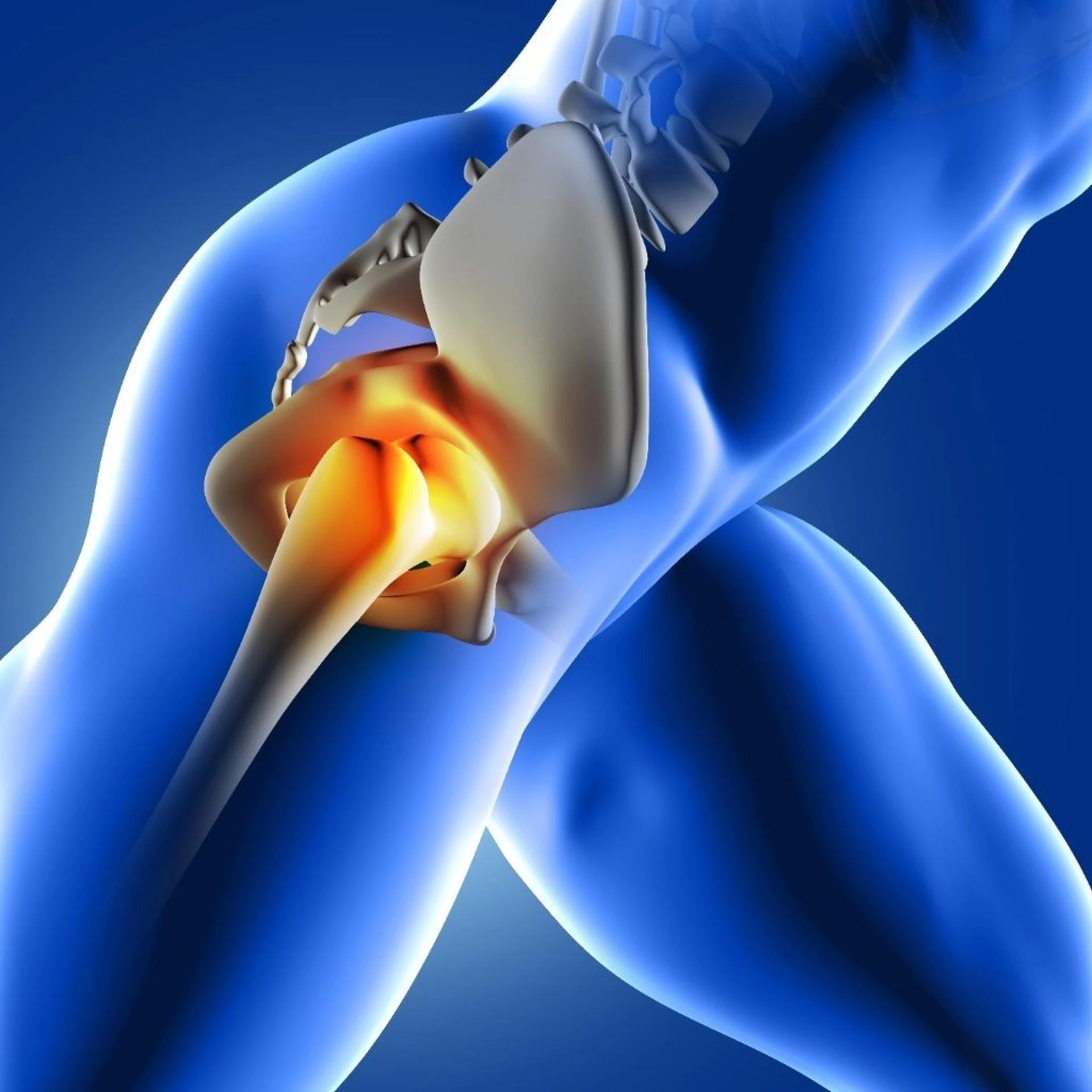 When Do You Need Hip Replacement Surgery? Key Signs to Watch