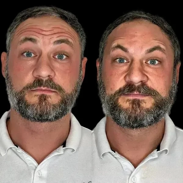 Profhilo Skin Reset Guided by Best Plastic Surgeon in dubai