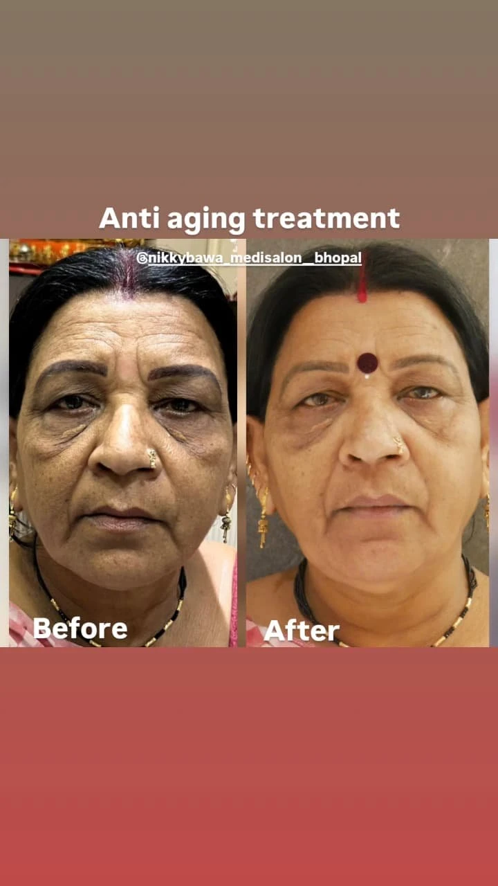 Anti-Ageing Fillers at Aesthetic Salon: 5 Proven Techniques for Long-Lasting Youth