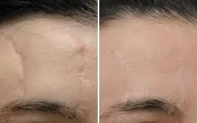 Scar Revision Surgery in Gurgaon: Advanced Solutions for Smoother, Healthier Skin