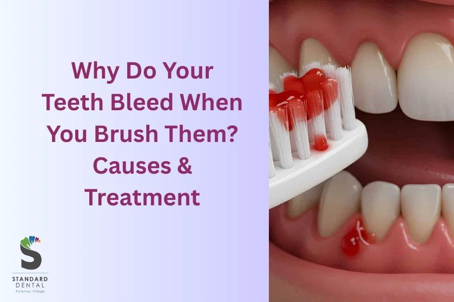 Why Do Your Teeth Bleed When You Brush Them? Causes & Treatment