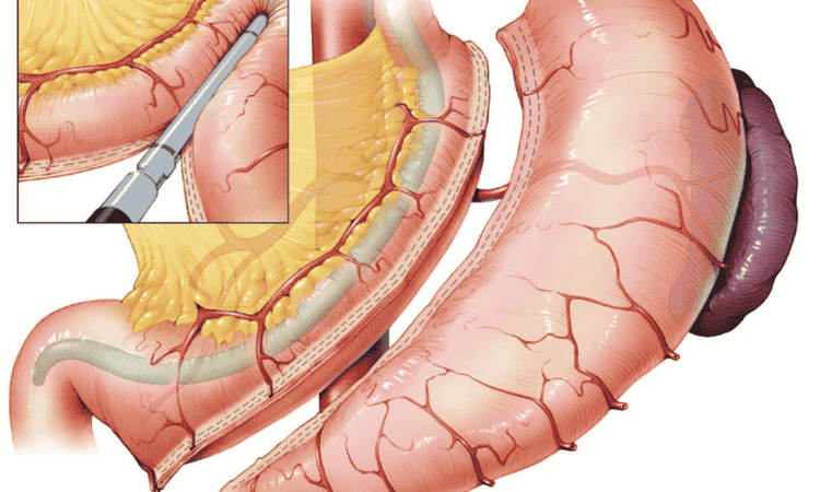 How Gastric Sleeve Surgery Supports Sustainable Weight Loss